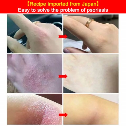 [Recipe imported from Japan] Herbal Anti-itch Psoriasis Cream