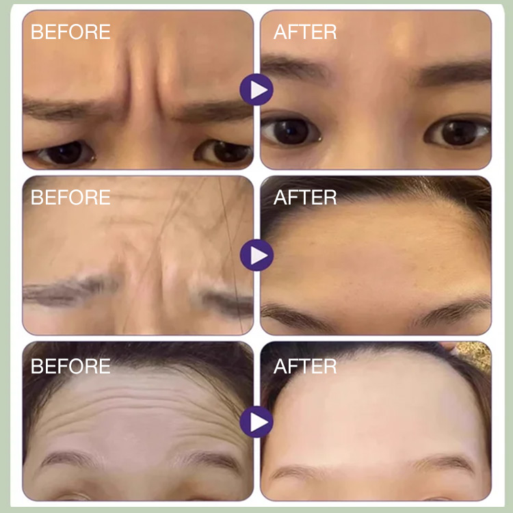 2025 New year promo  Buy 1 Take 1 and save 100 pesos - Tightening Anti-Wrinkle Sleep Patch - Perfect for lightening forehead wrinkles/glabellar lines/lines between eyebrows